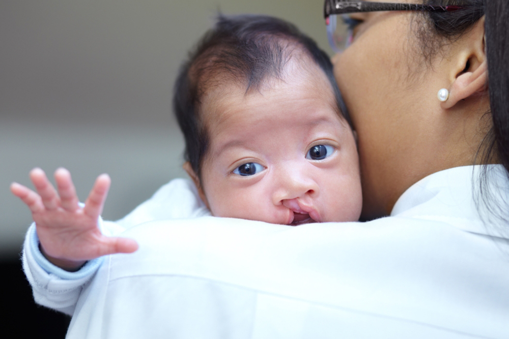 portrait of a baby girl who has a cleft palate looking over the shoulder of her mother